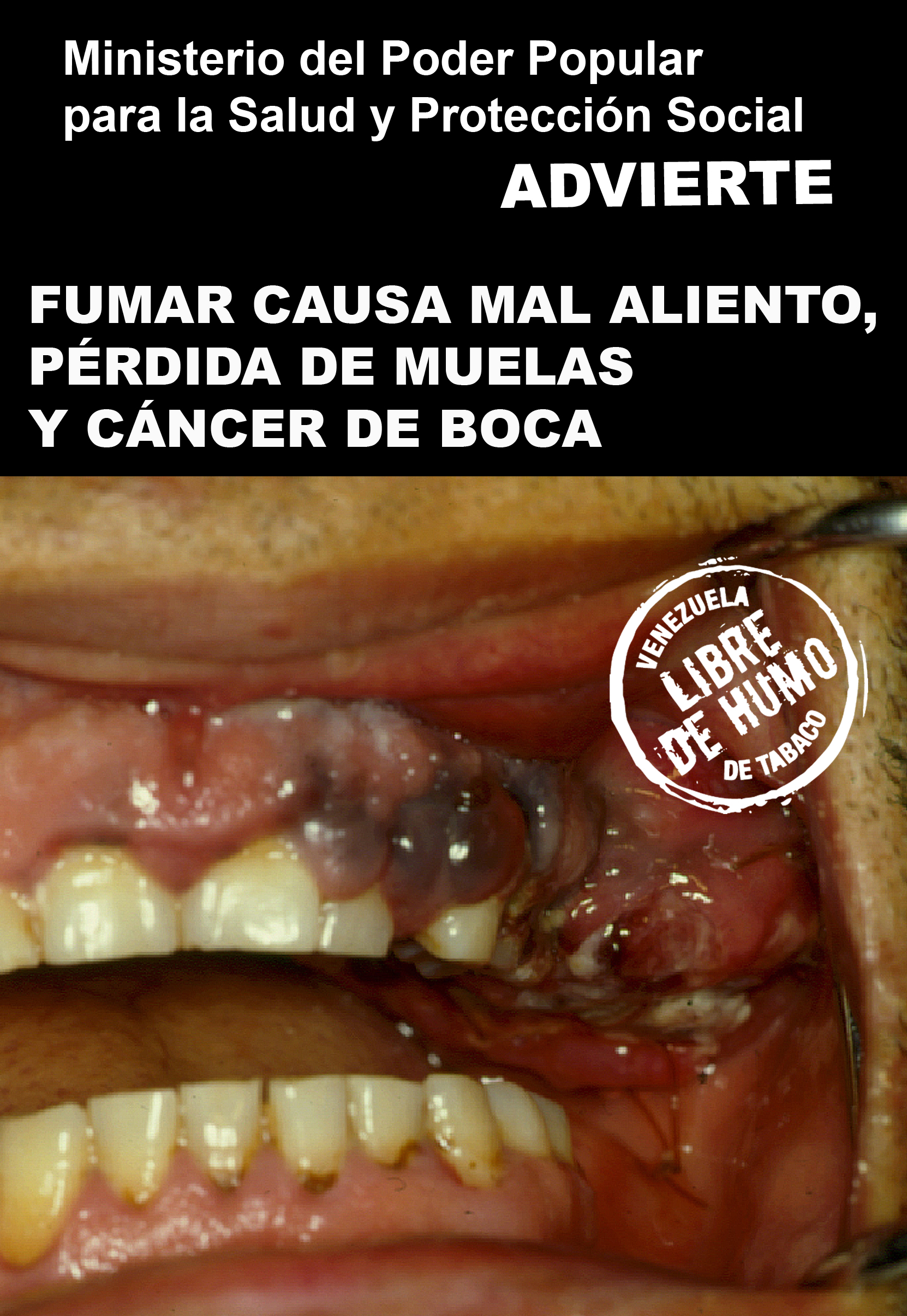 Venezuela 2009 Health Effects mouth - mouth cancer, gross